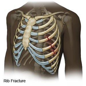 A Comprehensive Guide To Rib Fracture Injury Compensation Claims No